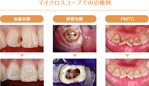 マイクロスコープでの治療例